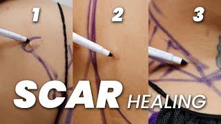 Scar Healing Secrets: Expert Tips