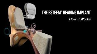 How Does the Esteem® Hearing Implant Differ From Hearing Aids?