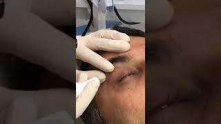 SKIN TAG TREATMENT AT SKY CLINIC