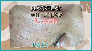 Big Cystic Acne Blackheads Extraction Blackheads & Milia, Whiteheads Removal Pimple Popping