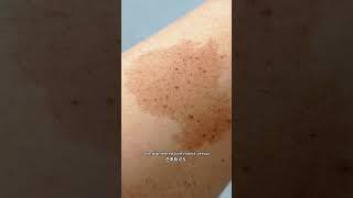 Topical Creams for Birthmarks | Ensoul Medical Clinic