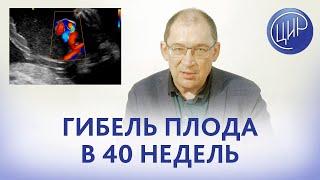 Антенатальная гибель плода в 40 недель, covid, обтурирующий тромбоз сосудов пуповины. Что делать?