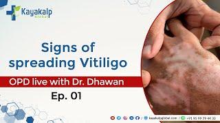 Signs of spreading Vitiligo | OPD with Dr. Dhawan |  @kayakalpglobal1 |  9599794433 | Safed daag ka ilaaj