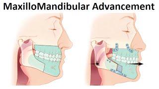 Surgical Treatment of Retruded Jaws (MaxilloMandibular Advancement Surgery) by Dr Mike Mew