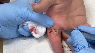 Removal of a pyogenic granuloma on the finger