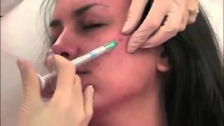 Radiesse Cheek Lift procedure by Dr.Anna Guanche