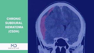 What is Chronic Subdural Hematoma (CSDH)? -  @mdmedicine-tv