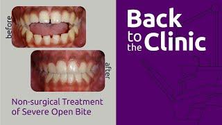Non-surgical Treatment of Severe Open Bite - Back to the Clinic #004
