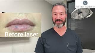 Venous Lake of the Lip/Lip Blister Treatment and Removal