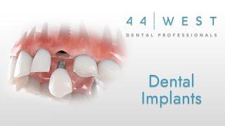 Dental Implants | Grandville Dentist | 44 West Dental Professionals