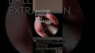 FUNGUS BALL EXTRACTION #breathebetter #sinusitis #fungus #snot #entsurgeon #allergies #surgery