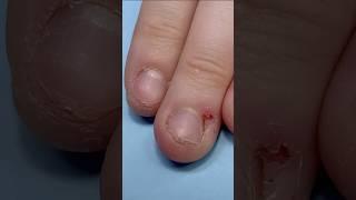 Bitten nails transformation to natural looking acrylic nails 