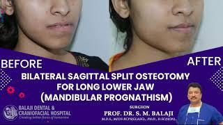 Bilateral Sagittal Split Osteotomy for Long Lower Jaw Mandibular Prognathism