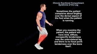 Chronic Exertional Compartment Syndrome - Everything You Need To Know - Dr. Nabil Ebraheim