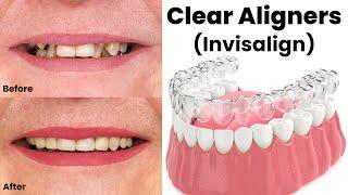 Clear Aligners (Invisalign) Price in Pakistan | Invisible Braces | Guide By Dr. Shahzad Mirza