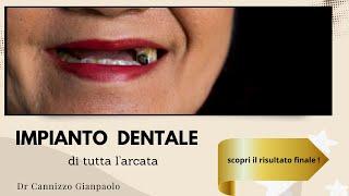 Impianti dentali - estetica dentale