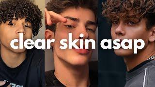 how to get clear skin for guys asap (no bs)