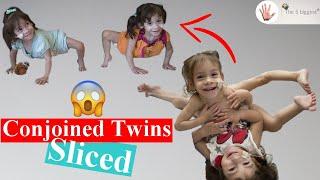 Conjoined Twins Eva and Erika: One Body Divided in Two! ~ Body Bizarre!