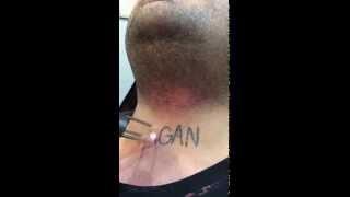 First Session Laser Tattoo Removal on Neck