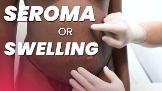 How to Handle Post-Op Swelling & Seroma Complications