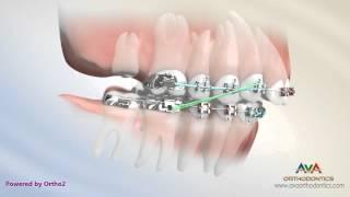 Orthodontic Treatment for Overbite (Overjet) - Removing Second Molar