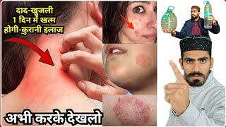 दाद खुजली खत्म करने के लिए सबसे शानदार वज़ीफ़ा_Very Strong Wazifa to Remove Fungal infection in Hindi