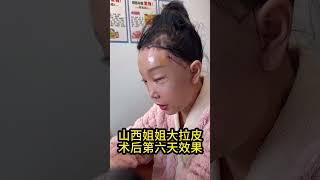 大拉皮第六天效果#整形 #医美 #facelift #大拉皮 #拉皮