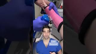 Orthopedic surgeon discusses fiber glass cast removal for a broken wrist