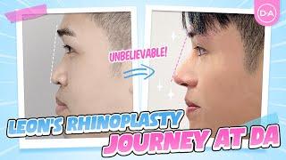 [Plastic Surgery Korea] Leon's Rhinoplasty Journey at DA Plastic Surgery