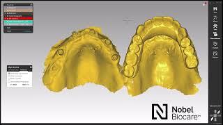 How to design your NobelProcera® full arch cases using iCam and exocad™