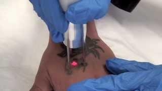 Q-Switched Nd:YAG Tattoo Removal Laser -- The Astanza Duality