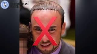 How To Take Hair Transplant Consultation Photos - by Joe Tillman