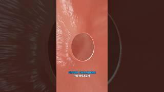 Repairing a hole in your heart (3D Animation)