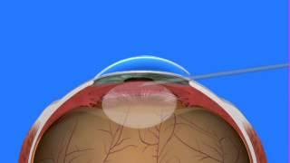 Cataract Surgery