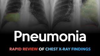 Lobar Pneumonia: Rapid Review of Chest X-rays