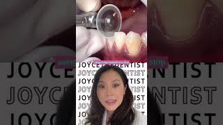 IPR (INTERPROXIMAL Reduction) using a Disc before Invisalign to create space #invisalign #shorts