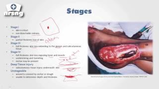 Pressure Ulcers NCLEX® Review | NRSNGacademy.com