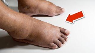 The BEST vitamin to remove swelling in the feet and legs