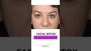 Magical under eyes filler and Botox with Dr. ORO