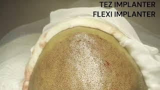 Tez Implanter Flexi Implanter Hair Transplant | Hair Transplant in Mumbai | Harleys Clinic