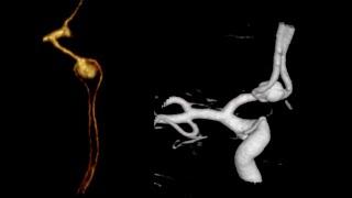  Previously Ruptured Coiled AcomA Aneurysm;  Now Recurrence!