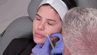 Dermal Filler Nasolabial Fold Treatment