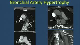 Imaging of Pulmonary Hypertension-- Philip Costello, MD (SCBT-MR/SABI 37th Annual Course)