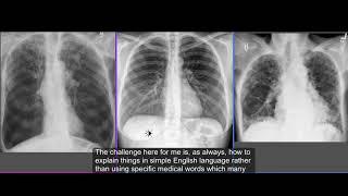 Chest Xray : Restrictive vs Obstructive lungs disease ( by hammadshams)