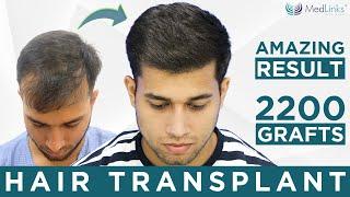 Perfect-i Hair Transplant ( 2200 Grafts in NW II) at MedLinks - Delhi, India