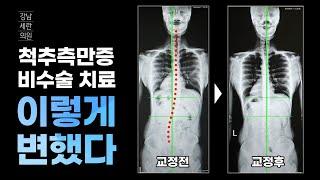 측만증 박사 1호 김수연 원장의 척추측만증 교정 전후 엑스레이 비교, 비수술 체형교정, 측만증 치료가 됩니다. #척추측만증  #scoliosistreatment