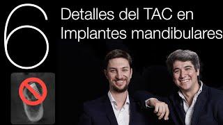  6 detalles IMPORTANTES del CBCT para implantes dentales en mandíbula - Implantología Básica