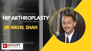 Hip Arthroplasty by Dr Nikhil Shah