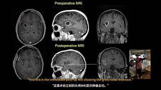 Microsurgery of Insular Gliomas