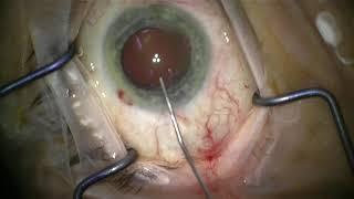 IOL removal and replacement - a guide for patients